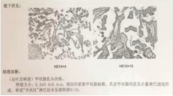別慌，甲狀腺疾病還可以這樣投保！