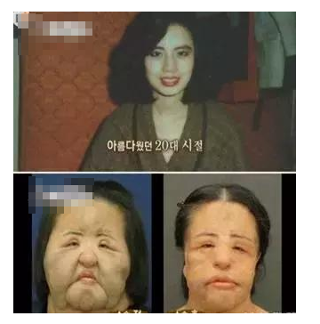 整容發(fā)生意外保險賠嗎？